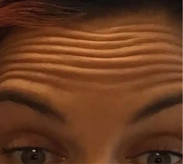 forehead-before