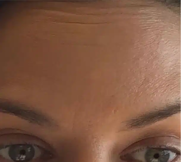 forehead-after