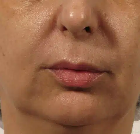 geneo face lips -before